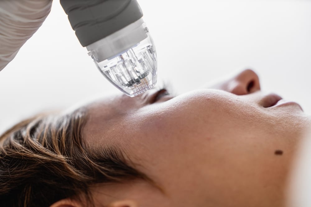 RF microneedling skin-tightening treatment