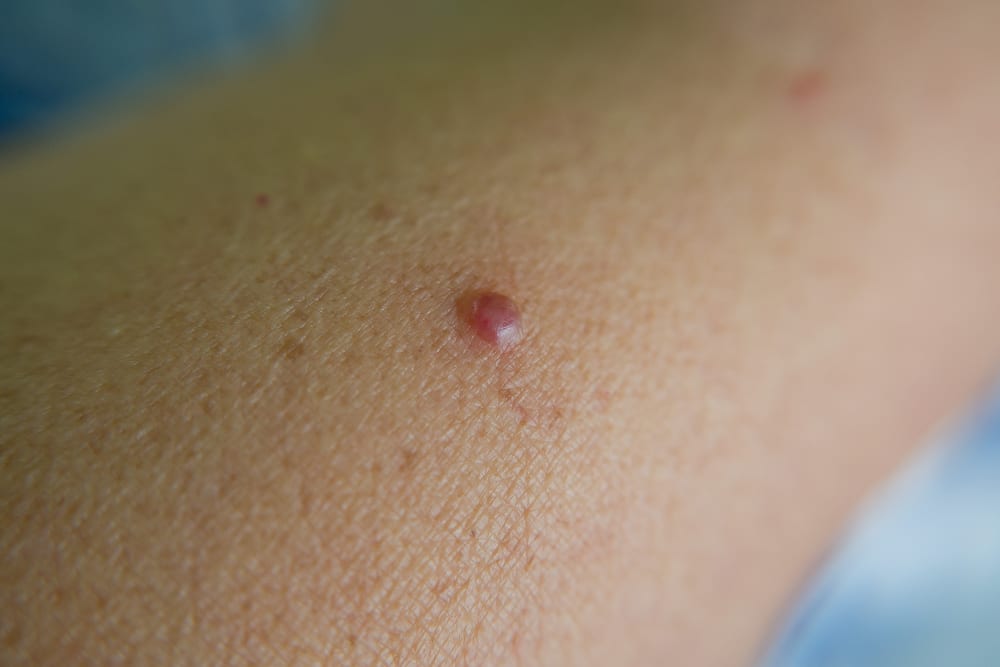 Cherry angioma laser removal