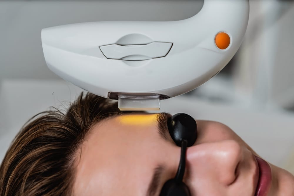 IPL photofacial treatment
